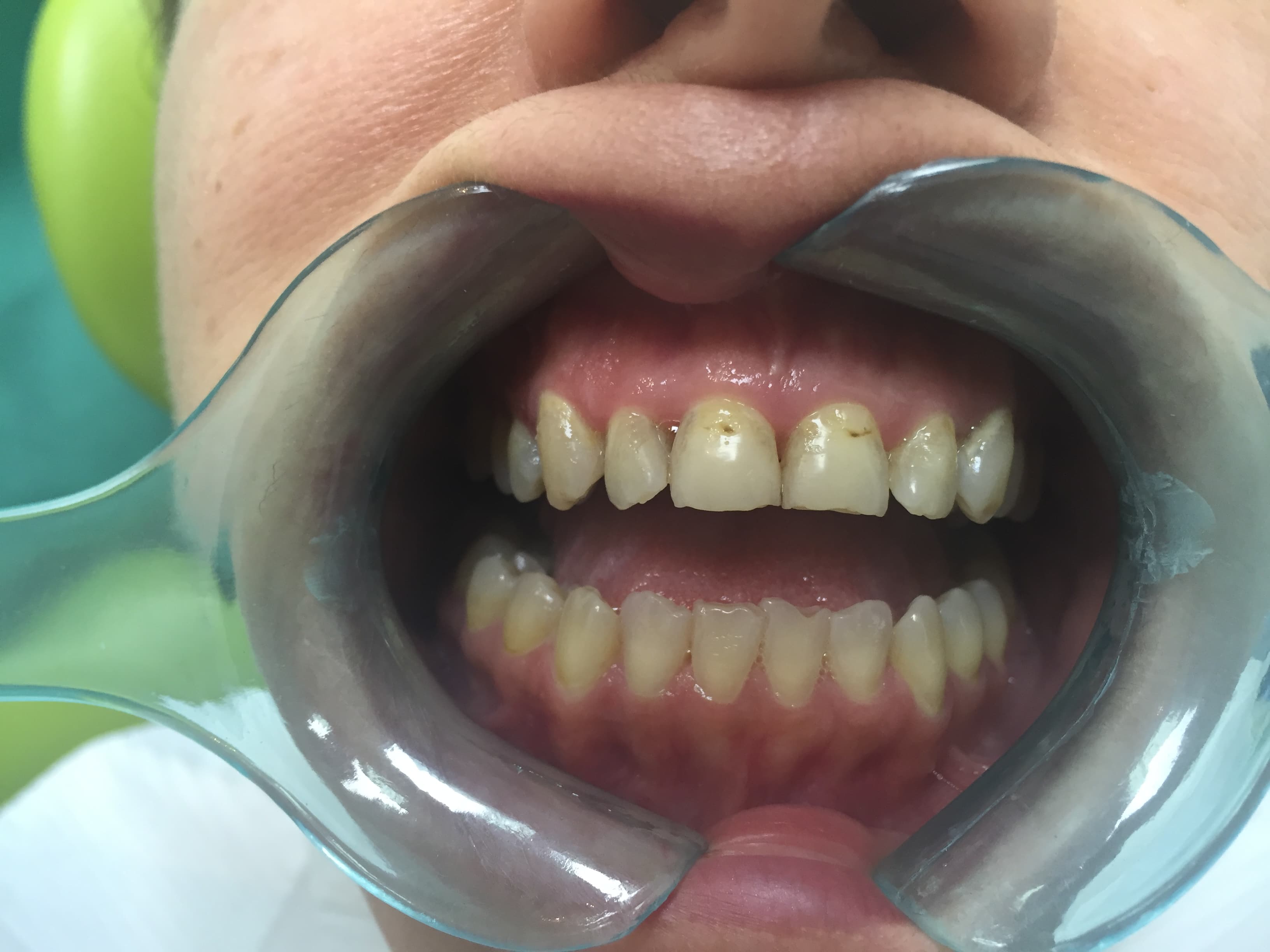 Composite Bonding before treatment
