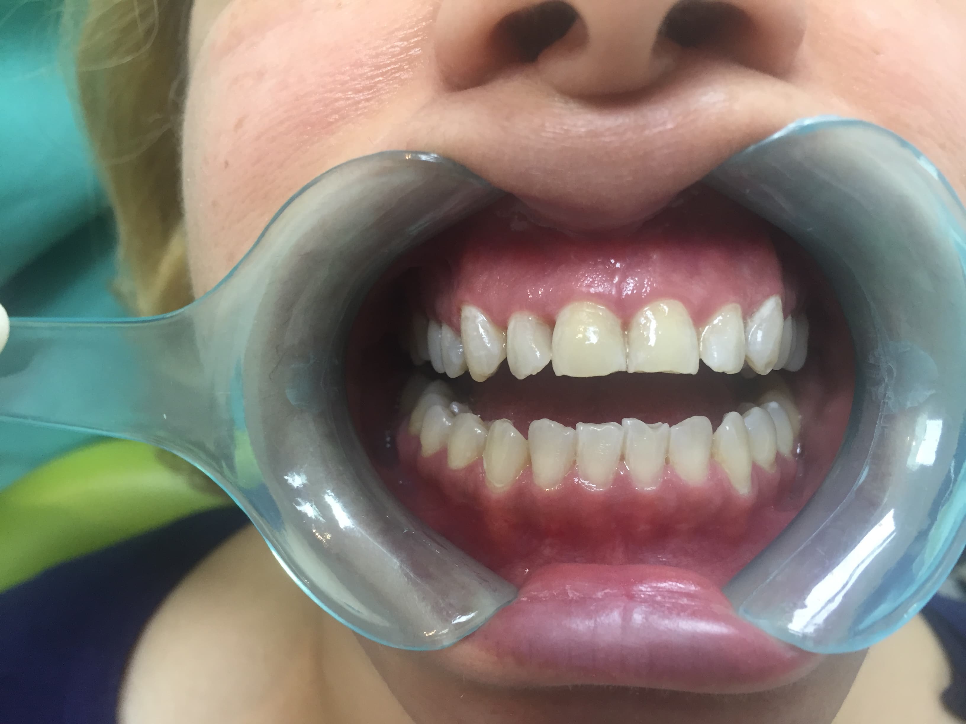 Composite Bonding after treatment