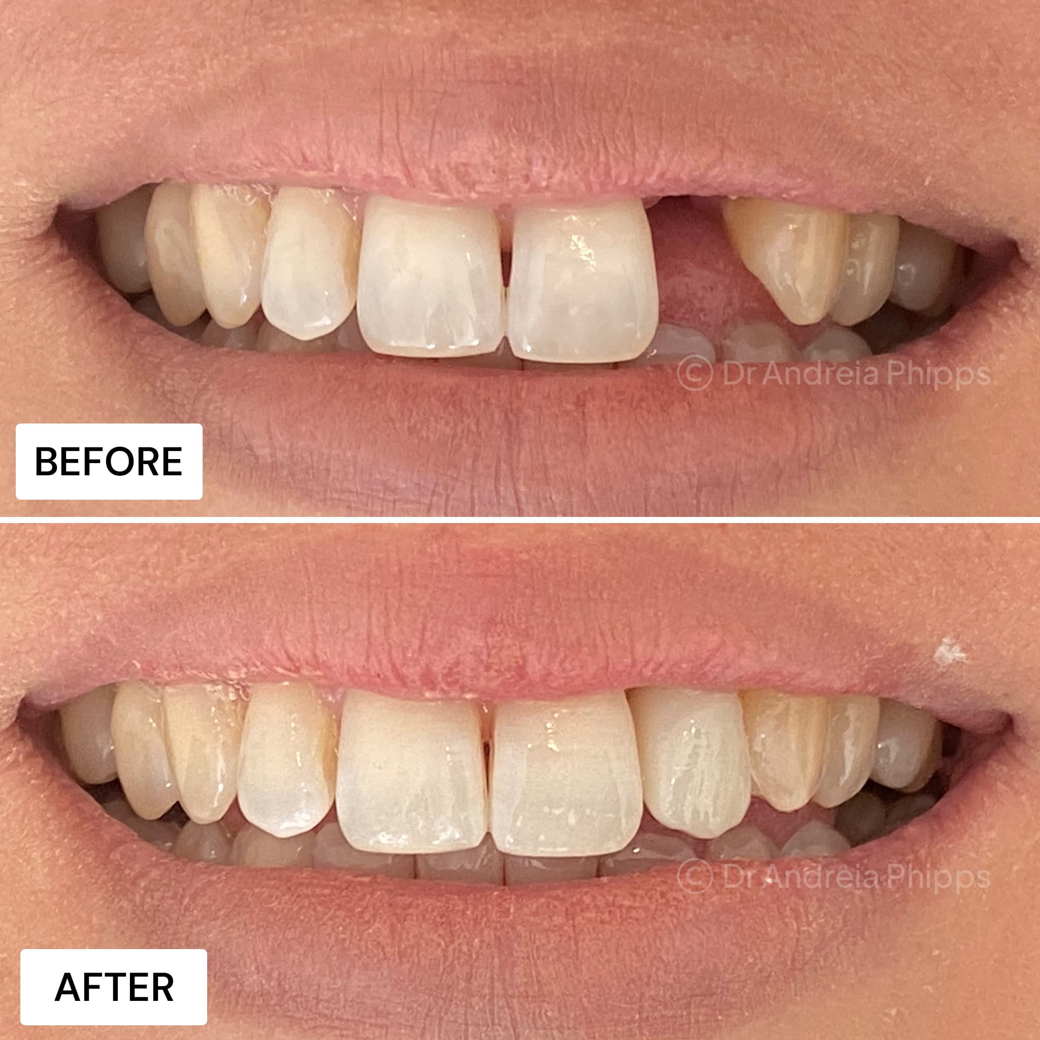 Smile transformation 11