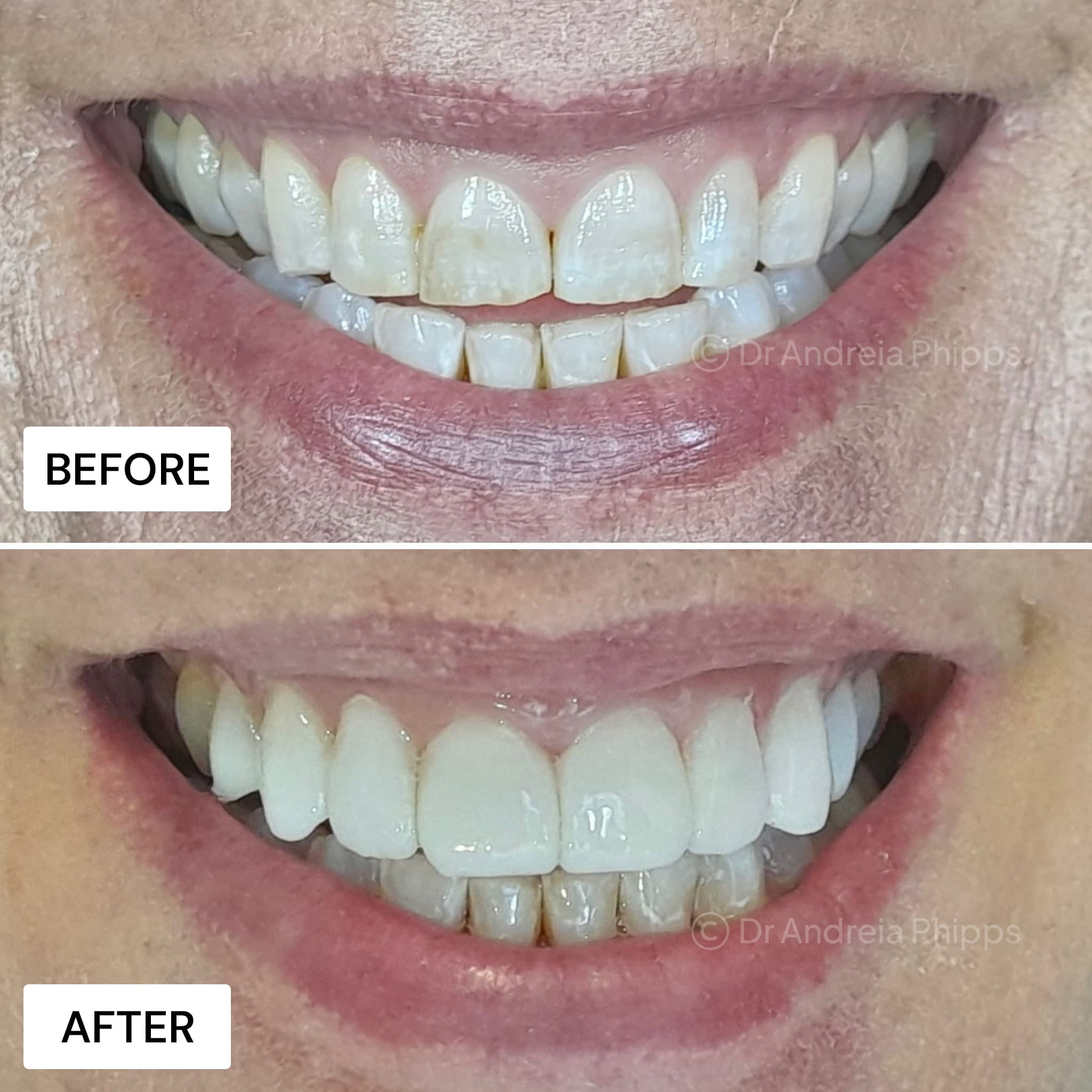 Smile transformation 4