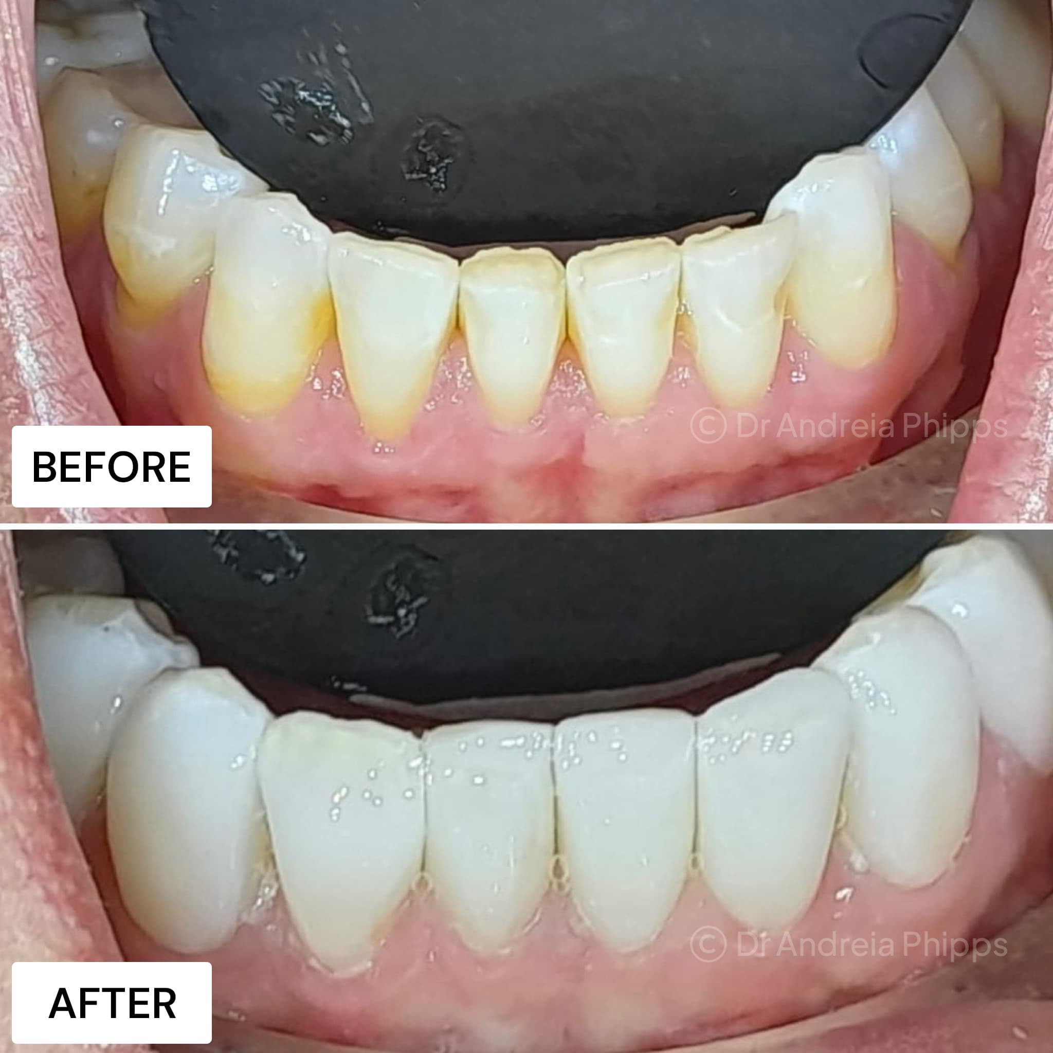 Smile transformation 3