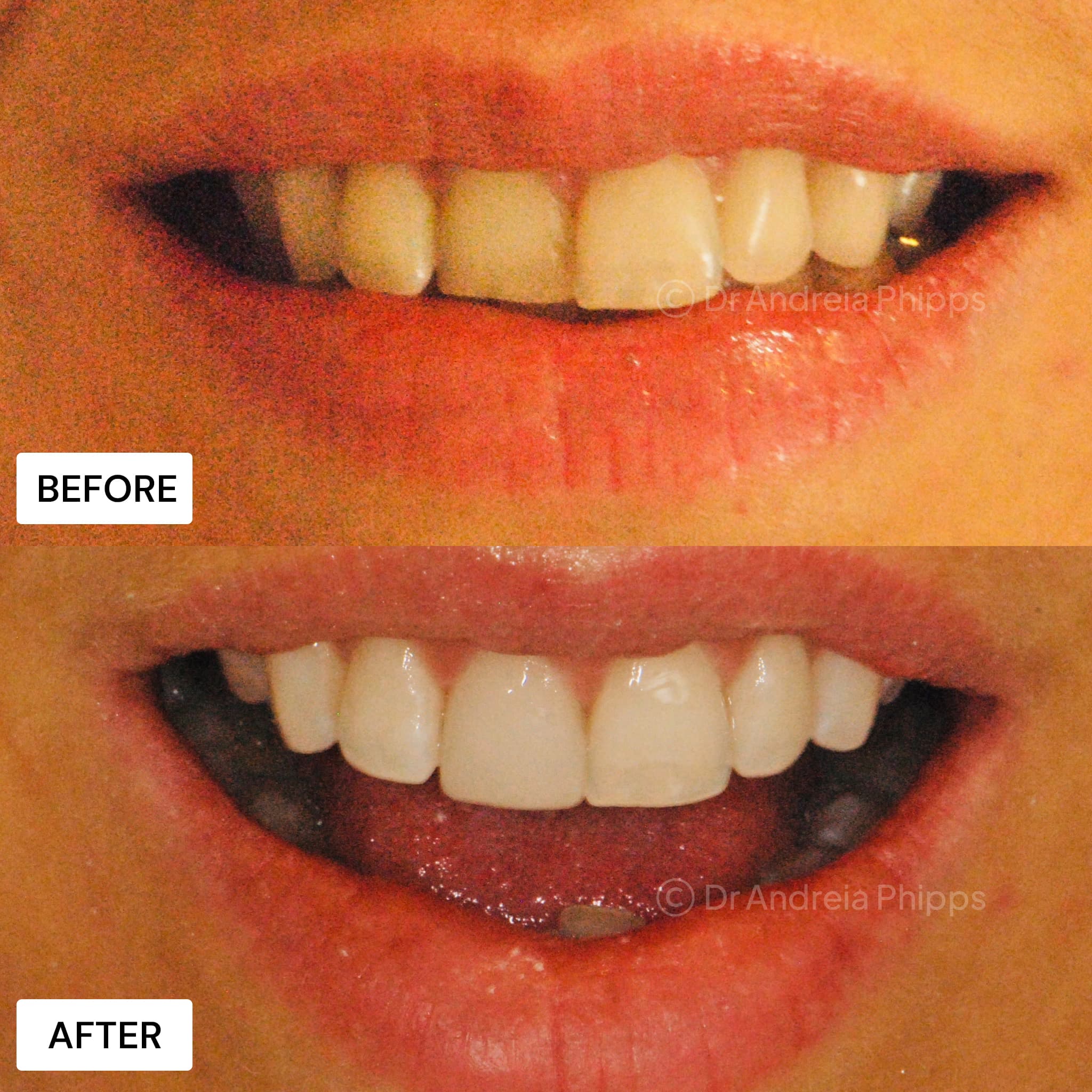 Smile transformation 5