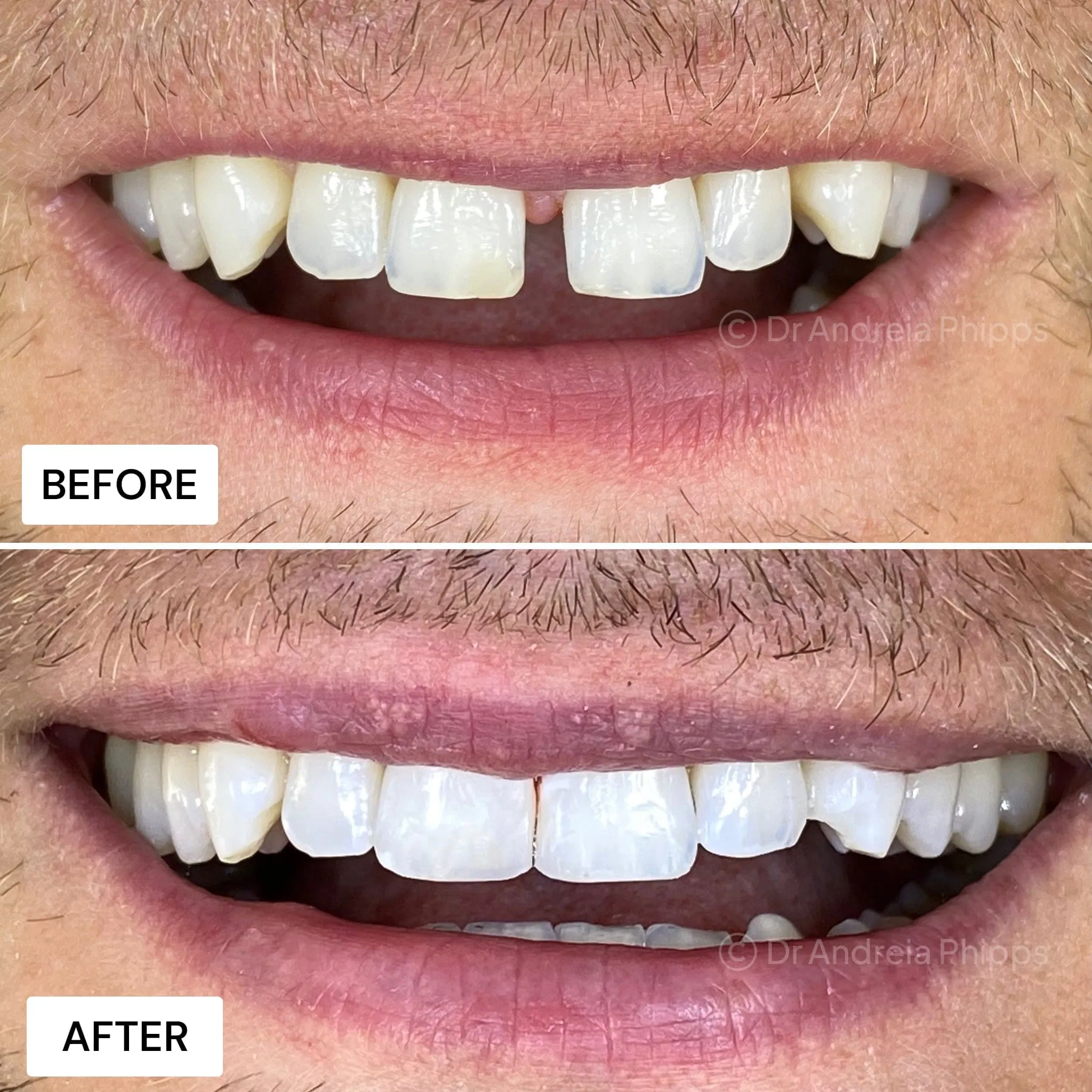 Smile transformation 6