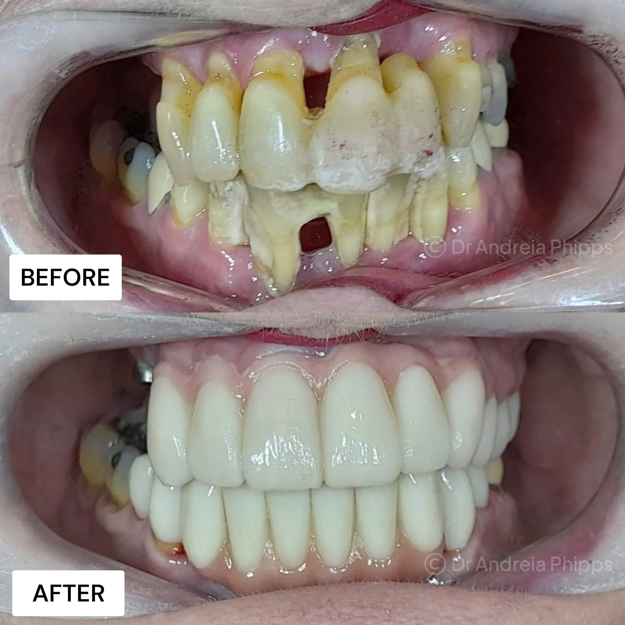 Smile transformation 14