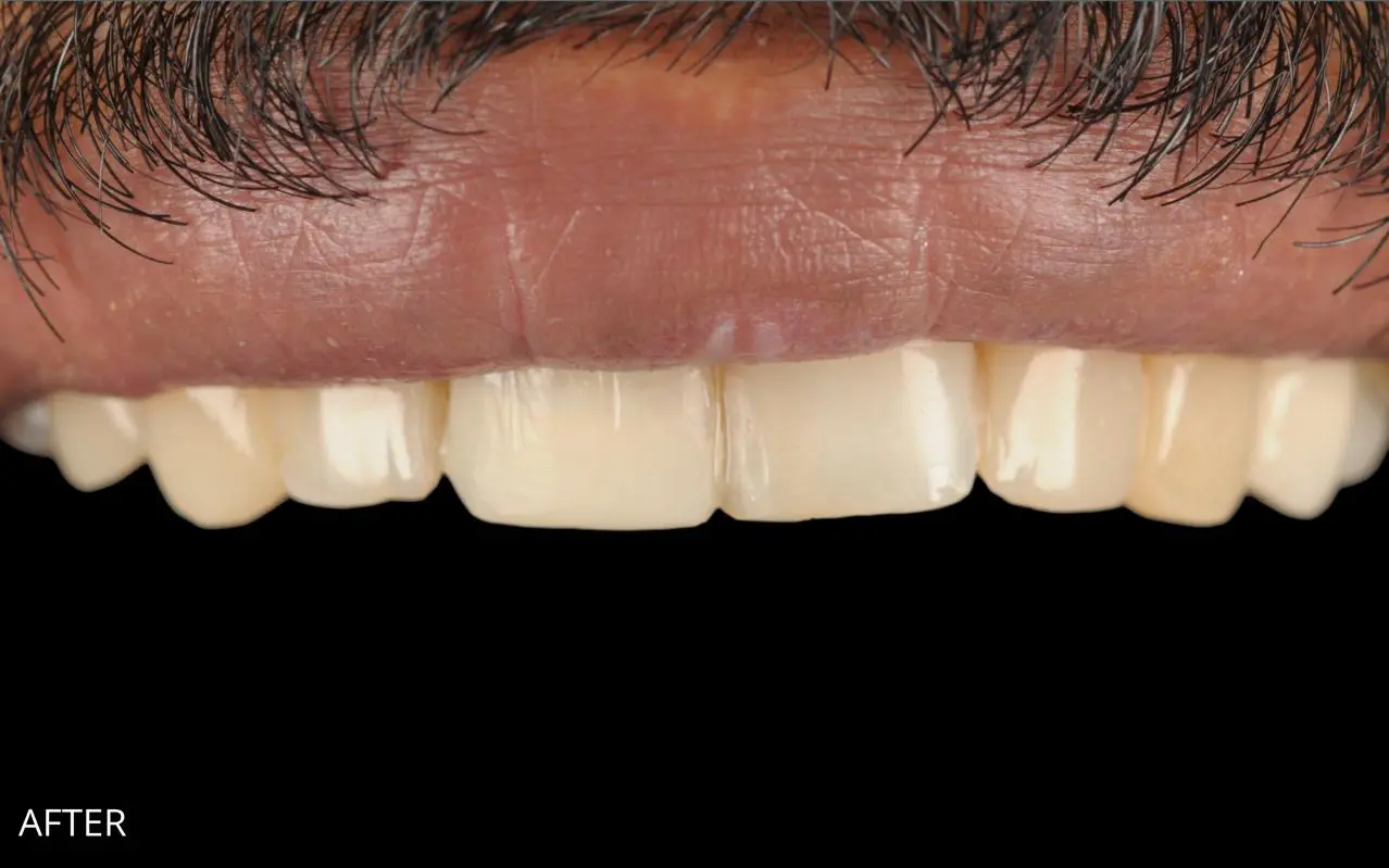 Before and after results of a dental restorative procedure performed by an experienced dentist at St Paul's Medical and Dental.