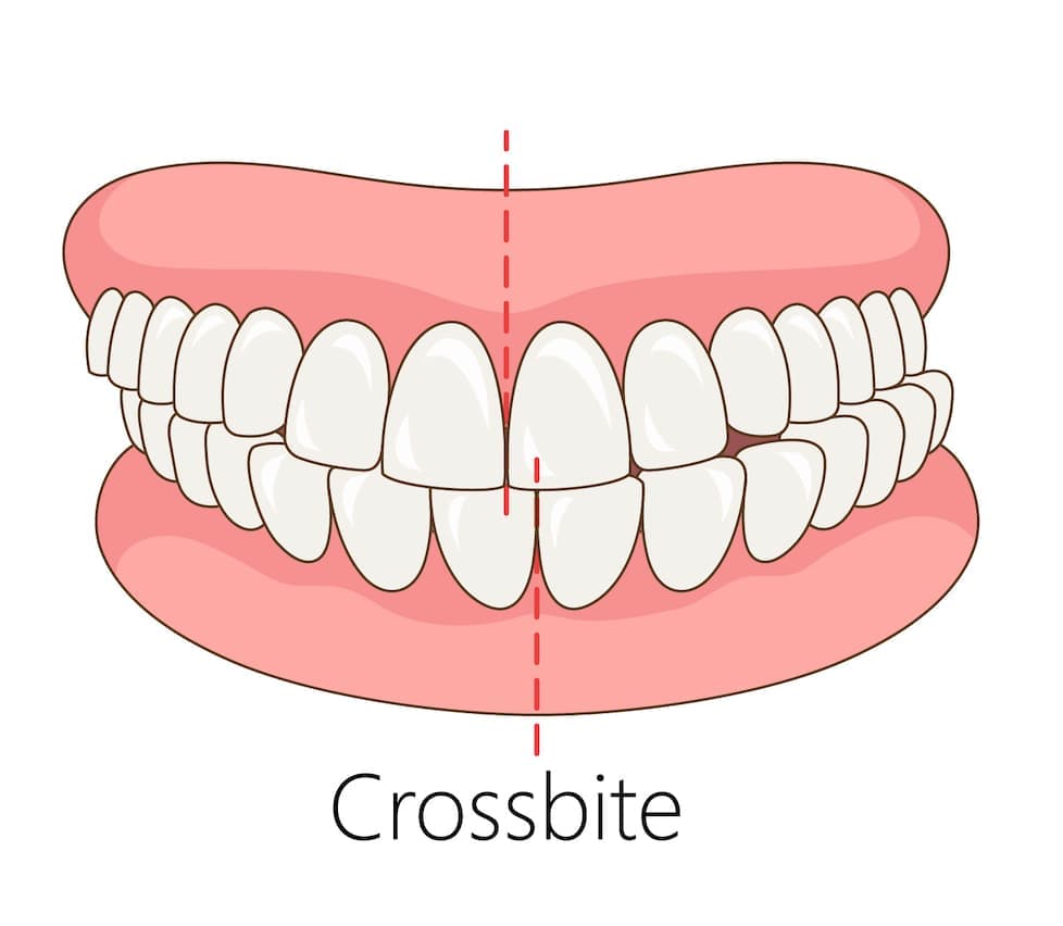 Crossbite symptoms, causes and treatment options – dental condition guide by St Paul's Medical and Dental