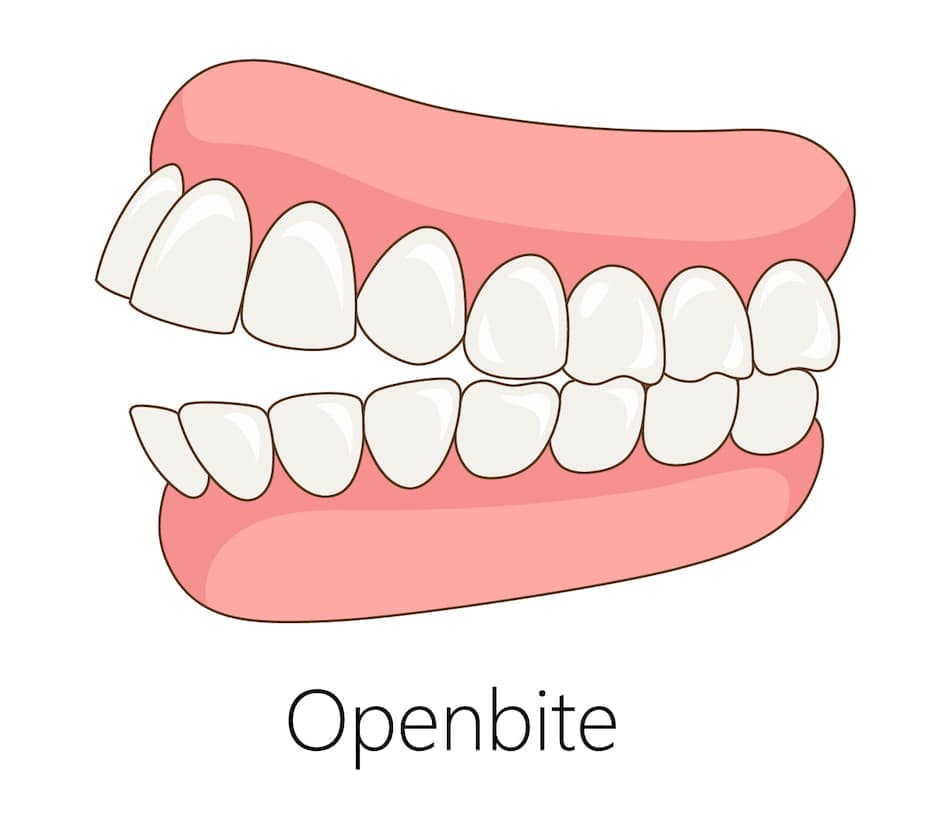 Open bite causes, symptoms and treatment options β dental condition guide by St Paul's Medical and Dental