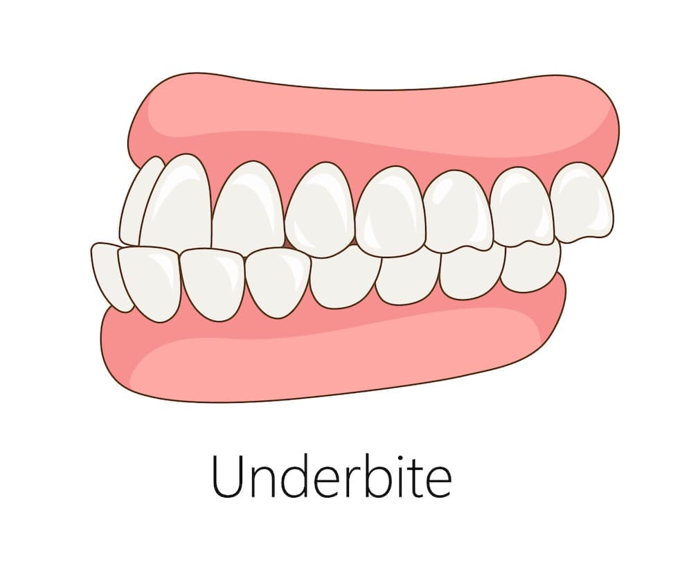 Underbite causes, signs and treatment options β dental condition guide by St Paul's Medical and Dental