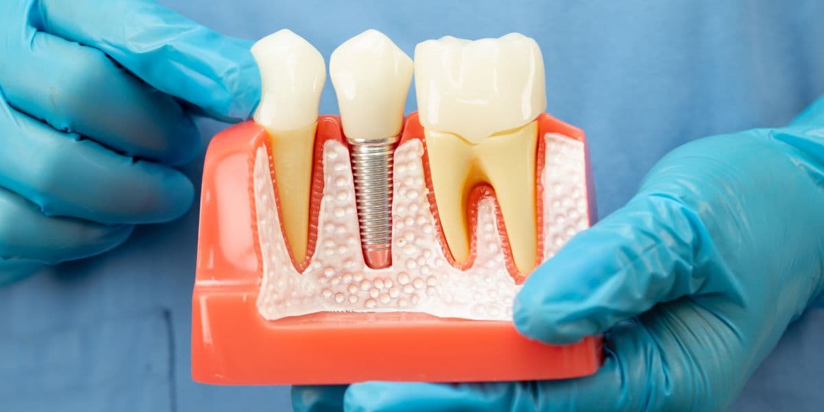 Dental Implants for False Teeth: Full Mouth Cost Guide UK