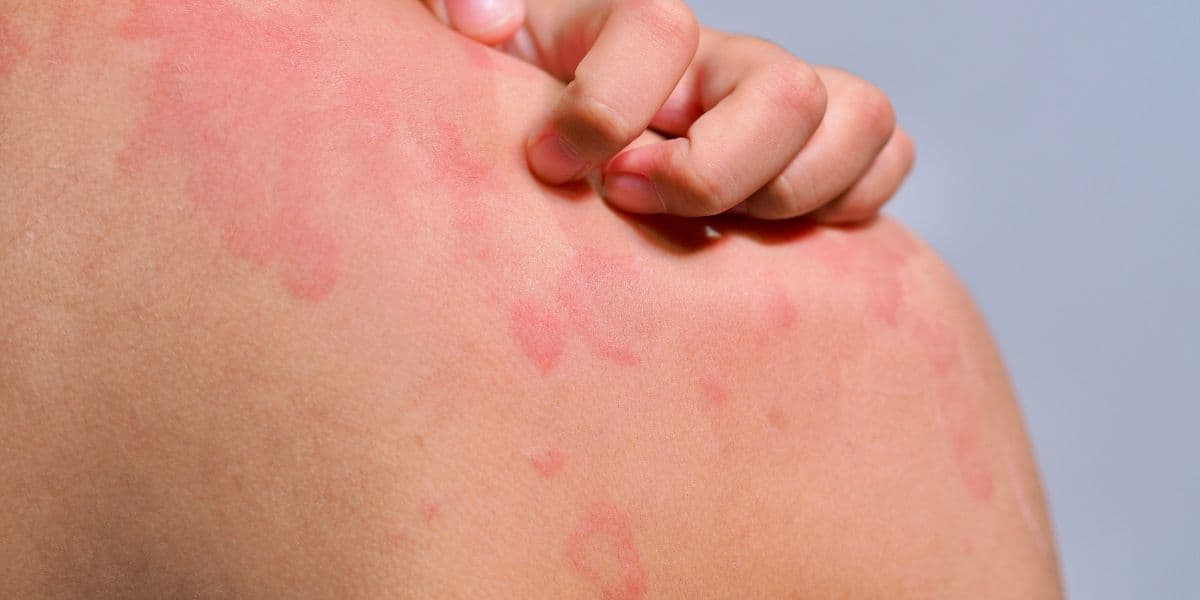 Raised red hive rash on skin showing typical urticaria pattern.