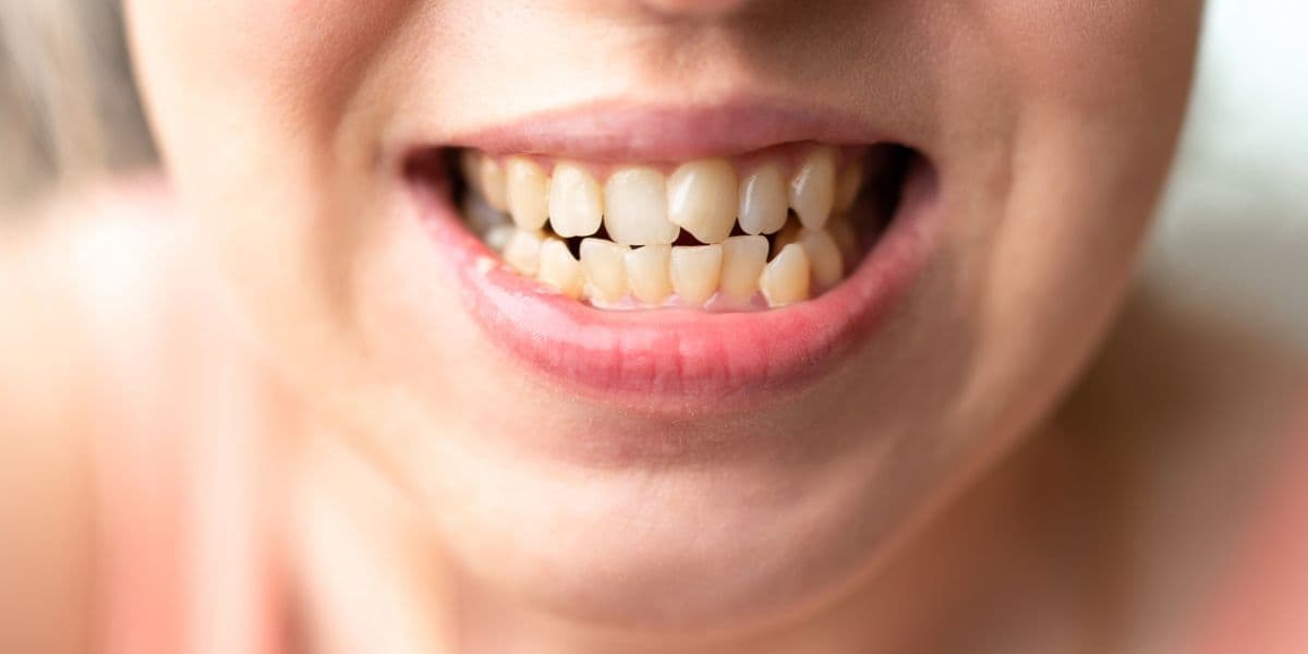 Composite bonding for crooked teeth before and after results guide