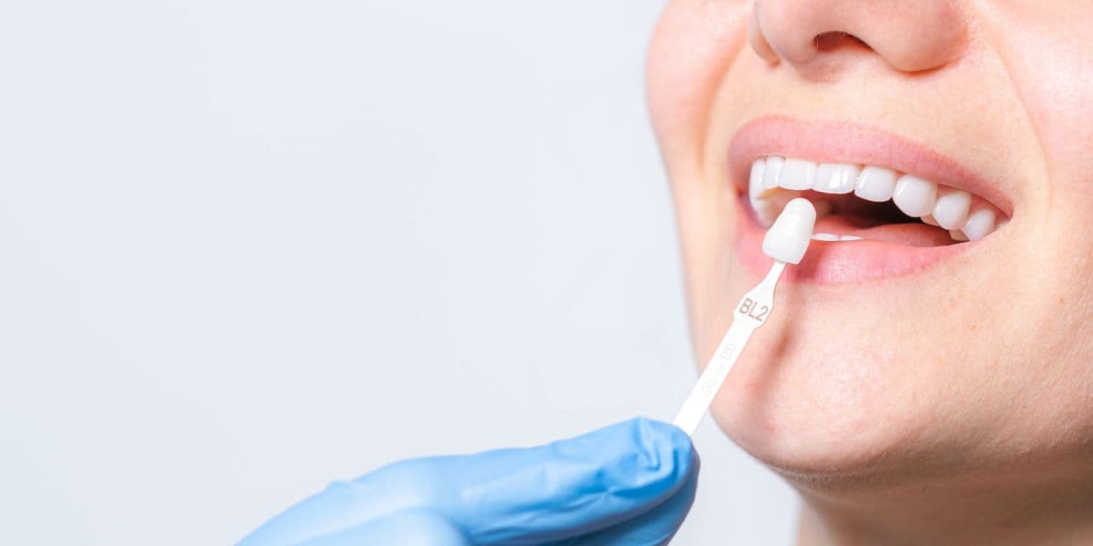 Veneers vs Composite Bonding: What's the Difference & Which Is Right for You?